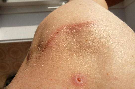 Cruso da UFSCar aborda o uso da Laserterapia no tratamento de feridas (Foto: Pixabay)