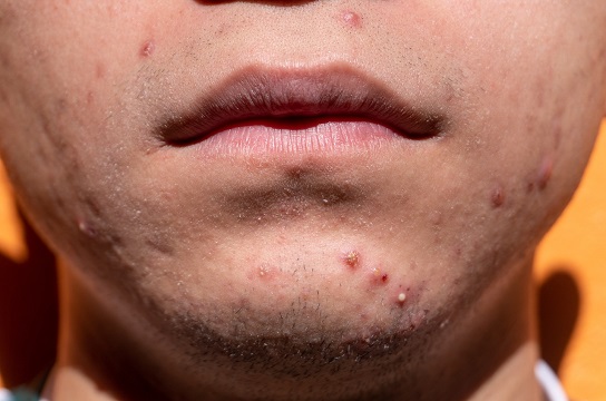 Pesquisa em Biotecnologia avalia tratamento inovador para acne